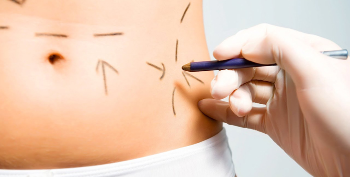 Tummy Tuck is Right for You! Getting Into Shape!
