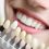 What is it Like to Get Dental Implants?